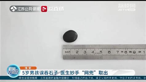 淮安一男孩误吞石子 医生妙手用“网兜”取出 我苏网