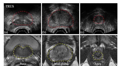 Prostate Segmentation In Transrectal Ultrasound Using Magnetic Resonance Imaging Priors