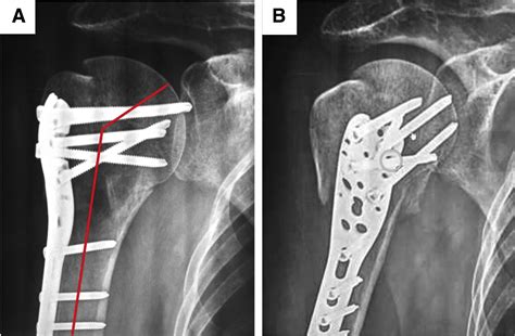 Fluoroscopic Technique For Open Reduction And Internal Fixation Of Proximal Humeral Fracture