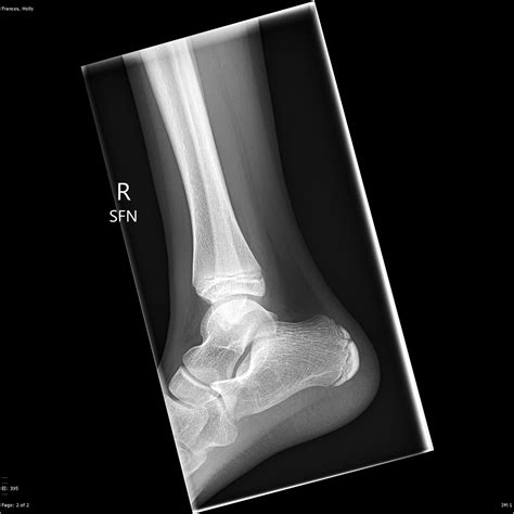 Calcaneal Avulsion Fracture Image Radiopaedia Org Hot Sex Picture