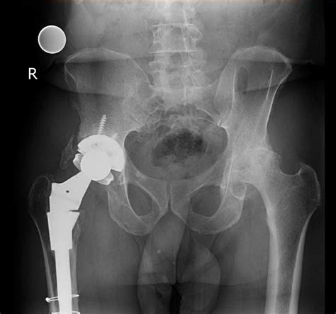 Anterior Hip Arthroplasty