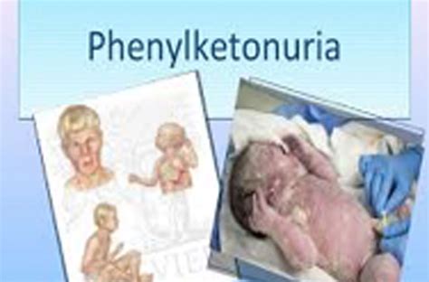 Phenylketonuria