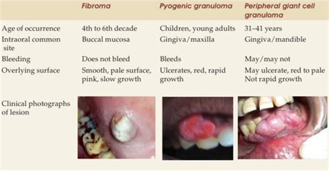 Peripheral Giant Cell Granuloma Vs Pyogenic Granuloma