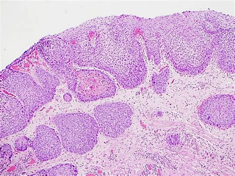 Pathology Outlines Squamous Cell Carcinoma Scc