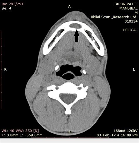 Figure 2 From Traumatic Bone Cyst Of The Anterior Mandibular Region A