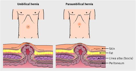 Apa Itu Umbilical Hernia Cash Has Ford