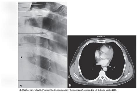 PA Oblique Sternum RAO Diagram Quizlet