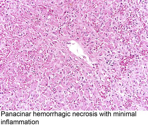 Pathology Outlines Hepatic Failure