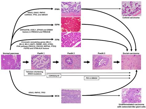 Cells Free Full Text Pancreatic Ductal Adenocarcinoma Molecular Pathology And Predictive