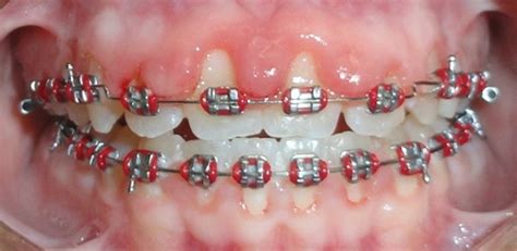 How To Get Rid Of Gingivitis With Braces