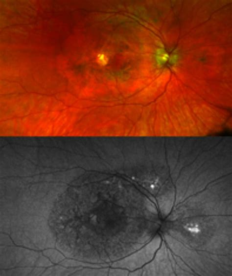 New Type of Macular Dystrophy Discovered - mivision