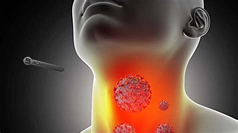 Tenggorokan Sakit Saat Menelan Ini Dia 7 Penyebab Dan Solusinya