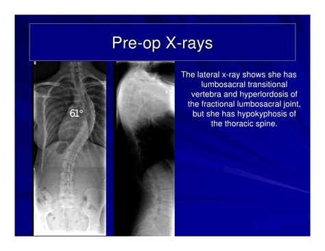 Case Review 4 Adolescent Idiopathic Scoliosis With 61 Degree Curvat