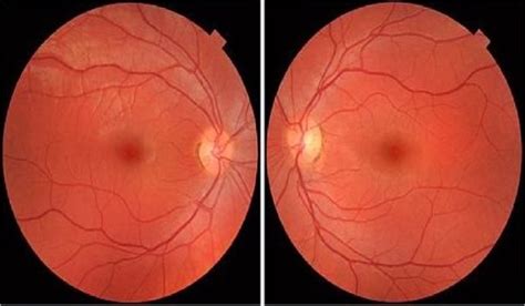 Fundus Image Of Normal Eye [18] Download Scientific Diagram