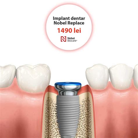 Implant Dentar Implant Dentar Pret Clinicile DentoCare