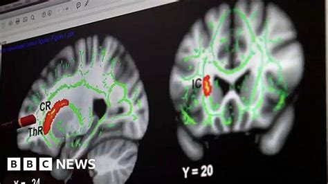 Are Paedophiles Brains Wired Differently Bbc News