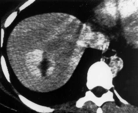 Imaging Of Atypical Hemangiomas Of The Liver With Pathologic Correlation Radiographics