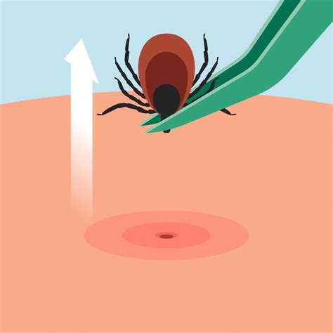 Comment Retirer Une Tique • Piqure De Tiquech