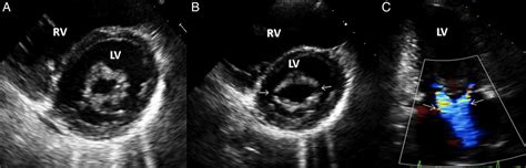 Update On Percutaneous Mitral Commissurotomy Heart