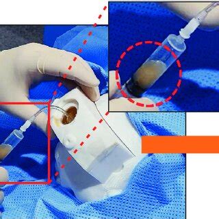 Drainage And Evaluation Of Artificial Cerebrospinal Fluid Using The