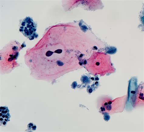 Trichomonas Vaginalis Slide