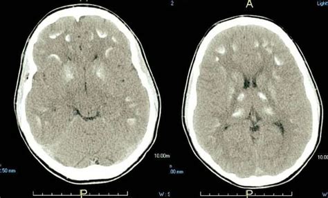 Mineralizing microangiopathy