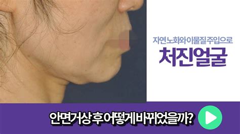 안면거상술잘하는성형외과 노블와이에서 안면거상수술 후 모습은 어떨까★더보기란 필독★ Youtube