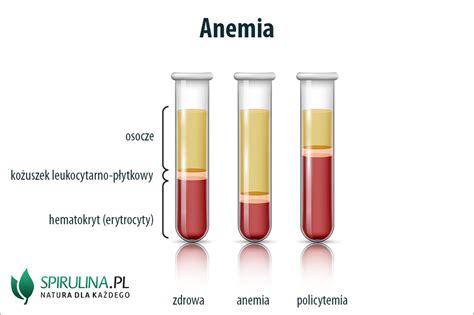 Anemia Przyczyny Objawy Leczenie Algi Spirulina I Chlorella