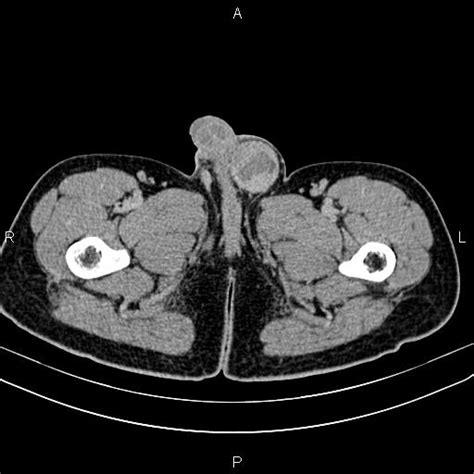 Paratesticular Embryonal Rhabdomyosarcoma Image