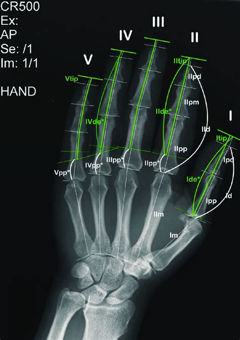 Anteroposterior X Ray Image Of The Hand With Quantities Measured