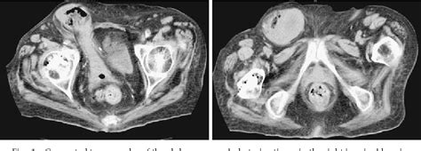 Right Inguinal Hernia Semantic Scholar