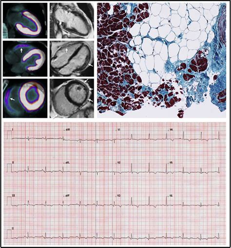 Arrhythmogenic Right Ventricular Cardiomyopathy Histology