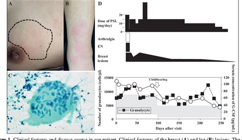 Figure From A Case Of Granulomatous Mastitis Erythema Nodosum And