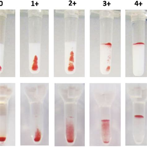 Incompatible Antiglobulinenhanced Gel Tube Agc And Compatible Gel