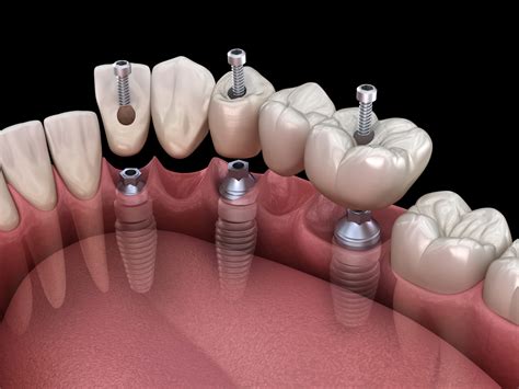 Supporting Dental Bridges With Implants Santa Rosa Ca