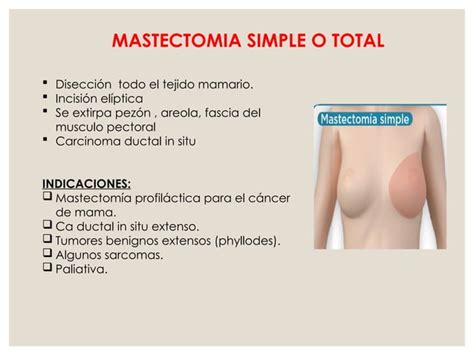 Cancer De Mama Ppt Residente De Ginecologia Y Obstetricia Ppt