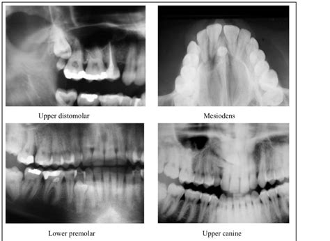 X-ray images showing different supernumerary teeth locations ...