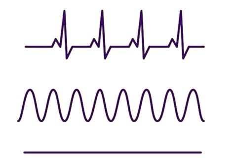 Quelle Est La Diff Rence Entre Une Crise Cardiaque Un Infarctus Ou Un