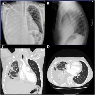 Upper Panel Posteroanterior A And Lateral B Views Of A Chest X Ray