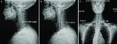 Illustration of radiographic parameters. (A) C2-7 Cobb angle is defined ...