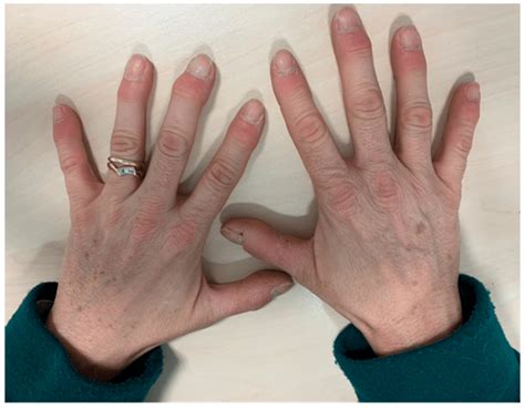 Proximal Interphalangeal Joint Swelling