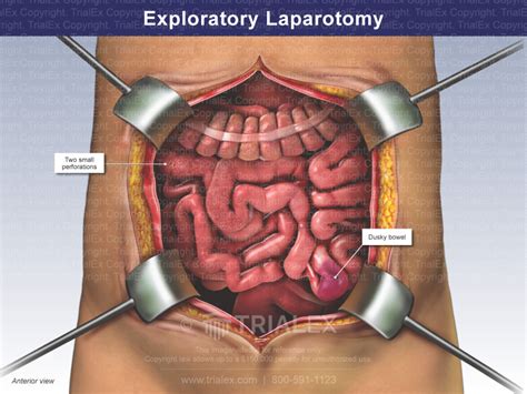 Exploratory Laparotomy Informacionpublicasvetgobgt