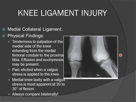 Medial Collateral Ligament Laxity Ezqmeceu Perry J Carpenter