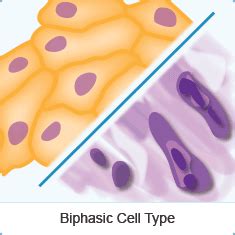 Biphasic Mesothelioma - Diagnosis, Treatment and Prognosis