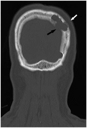 Intradiploic Encephalocele Of The Left Parietal Bone A Case Report