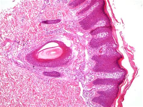 The Open Dermatology Journal Volume 12