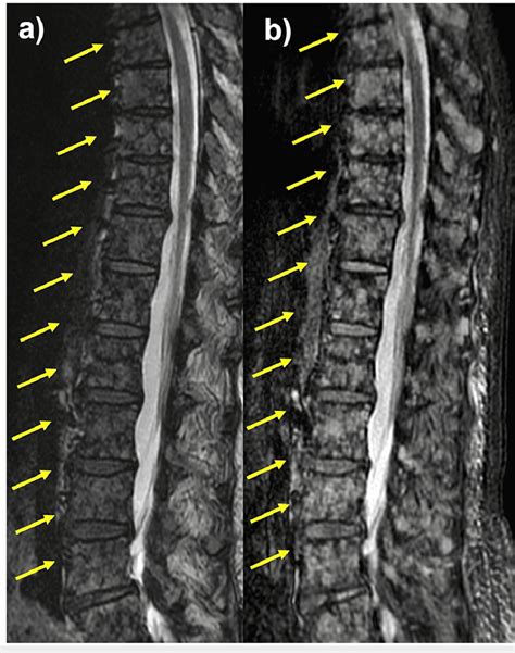 A lumbar spine MRI showing mottled high signal in the lumbar vertebral ...