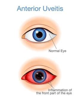 Uveitis: Symptoms, Causes and Treatment