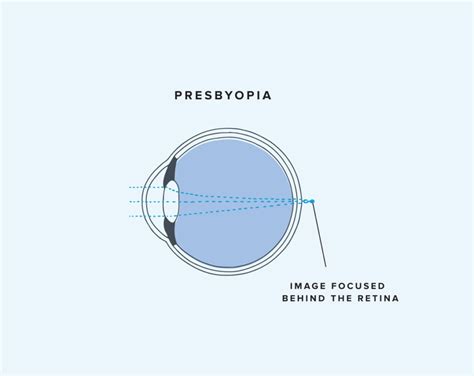 What Is Presbyopia Symptoms And Treatment Warby Parker