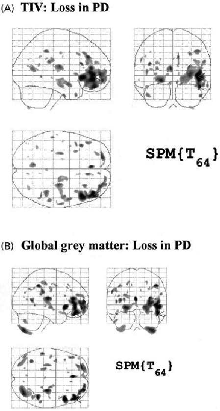 Grey Matter Volume Loss In Pdd Relative To Parkinsons Disease